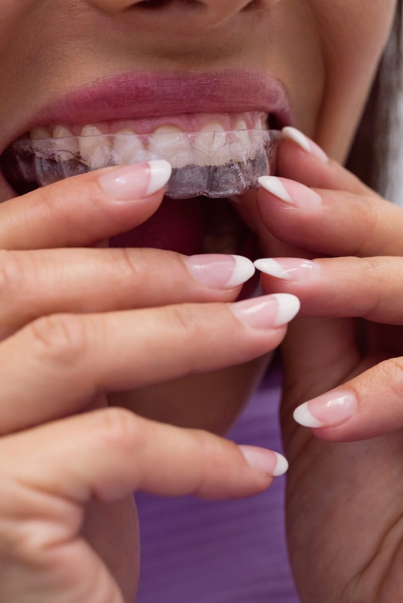 Woman inserting clear teeth aligner Woman inserting clear teeth aligner