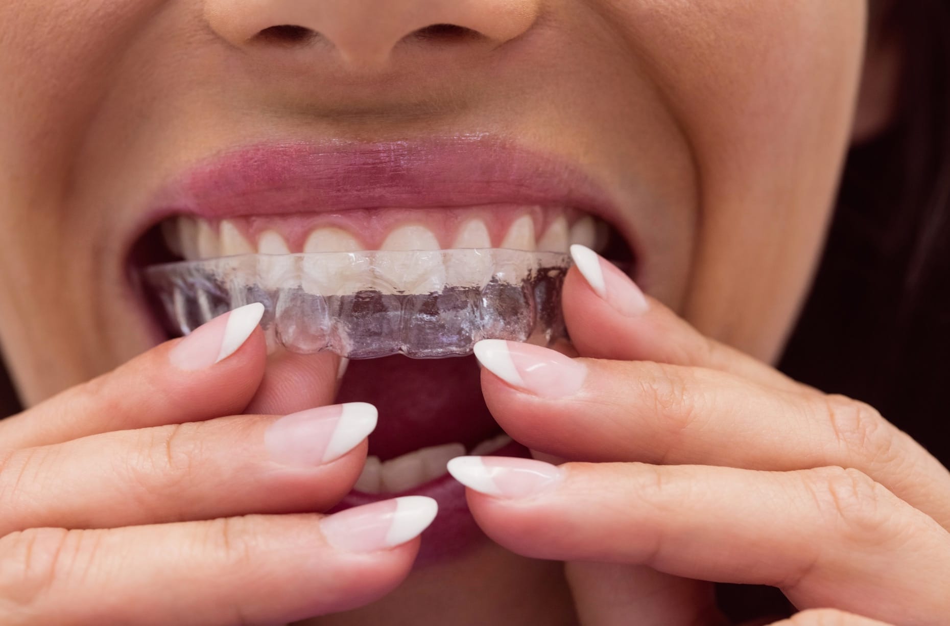 Woman inserting clear teeth aligner Woman inserting clear teeth aligner